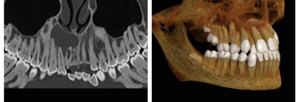 КТ-планирование перед имплантацией (хирургическая стоматология), стоматологического и ортодонтического лечения
